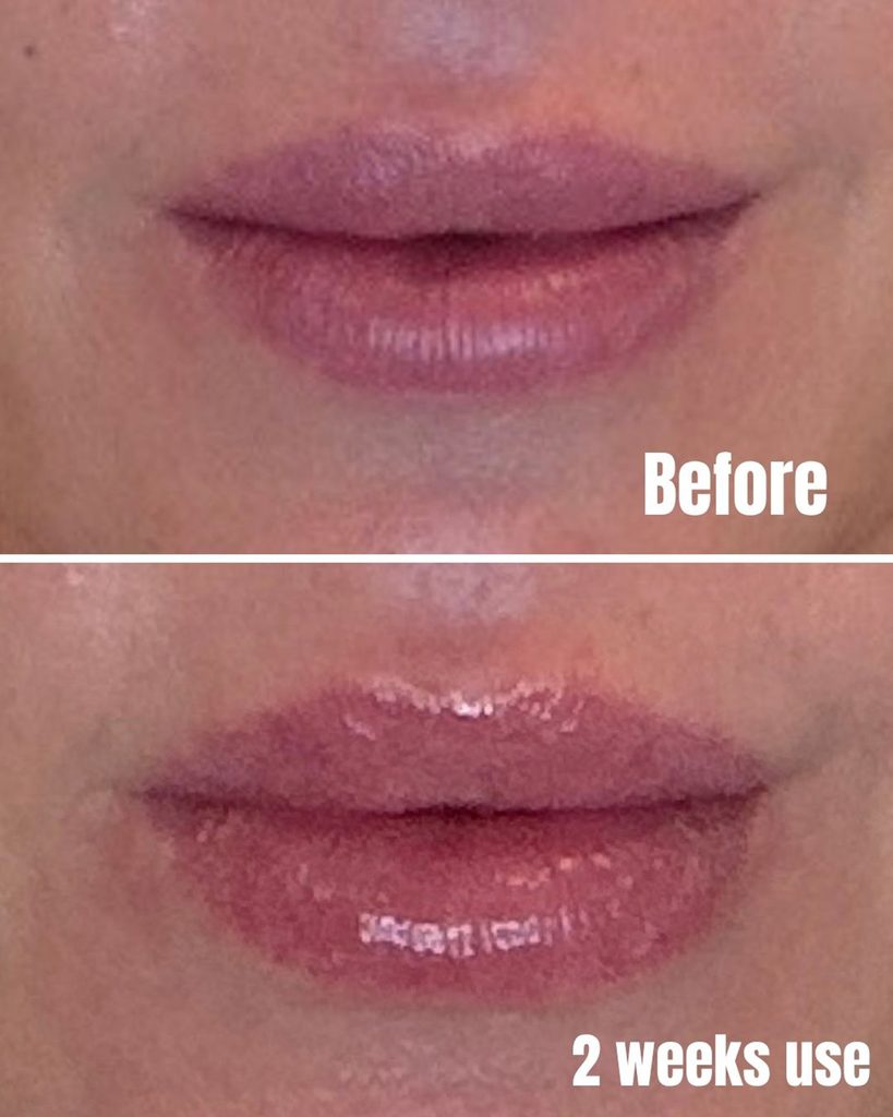 dr diamond liplift results before and after 2 weeks on a woman's lips