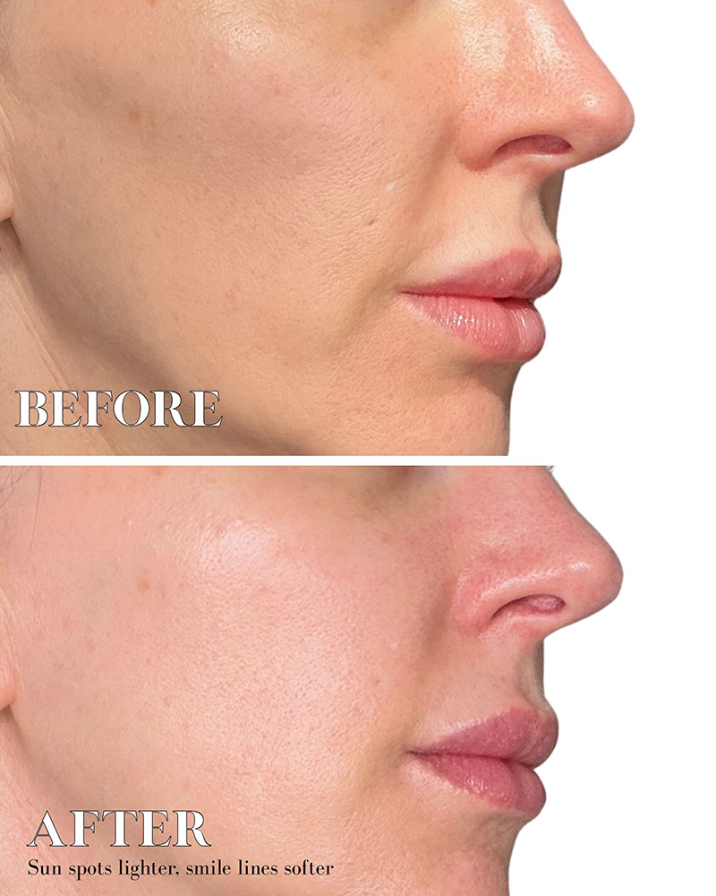 best anti-aging serum dr diamond plasma before after
