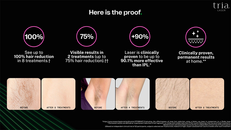 laser hair reduction tria 4x before after results