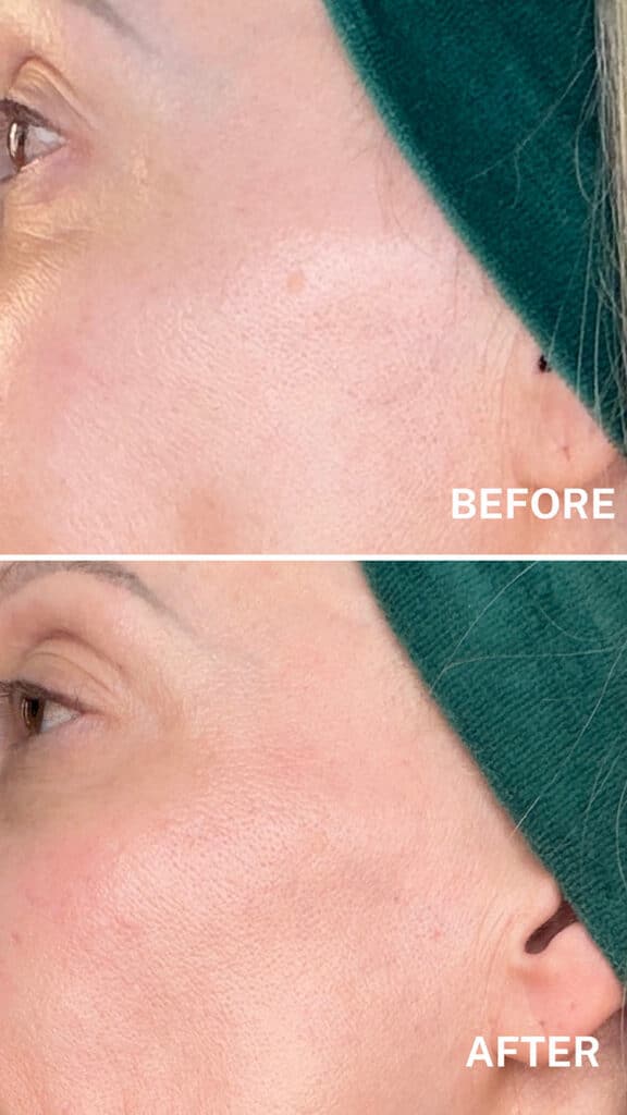currentbody before after results led mask series 2 melasma sun spots