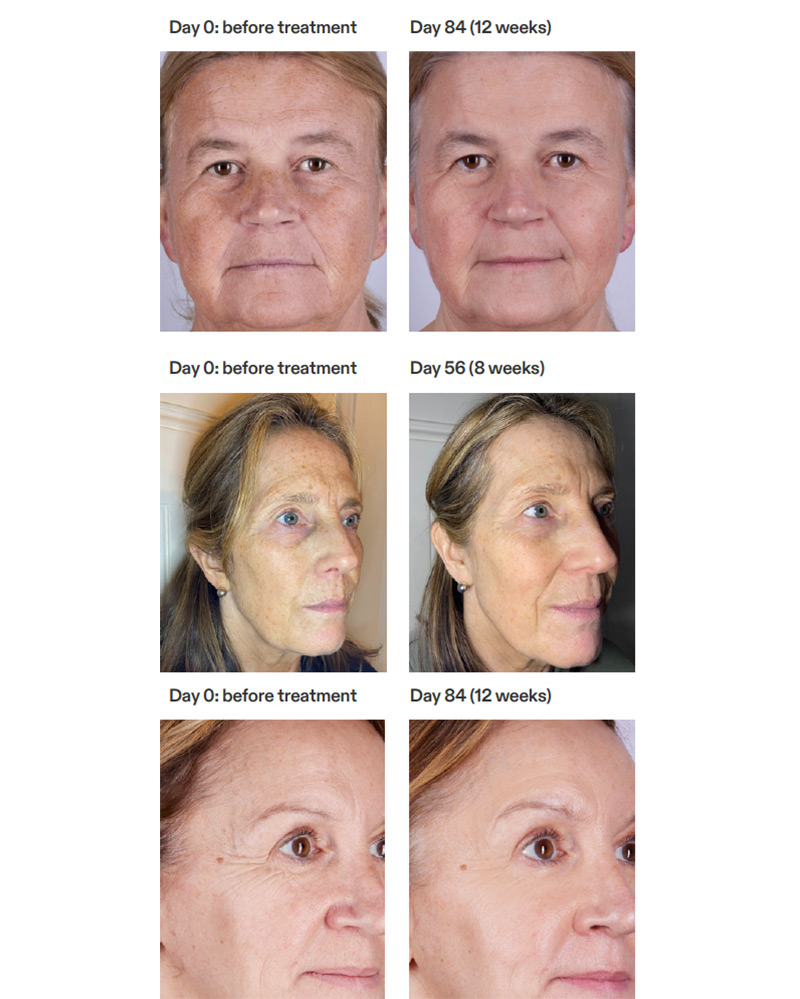 Currentbody led mask before and after face