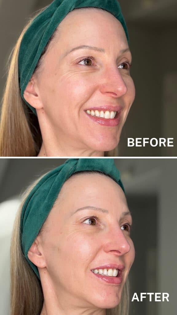 currentbody led mask before and after melasma sun spots