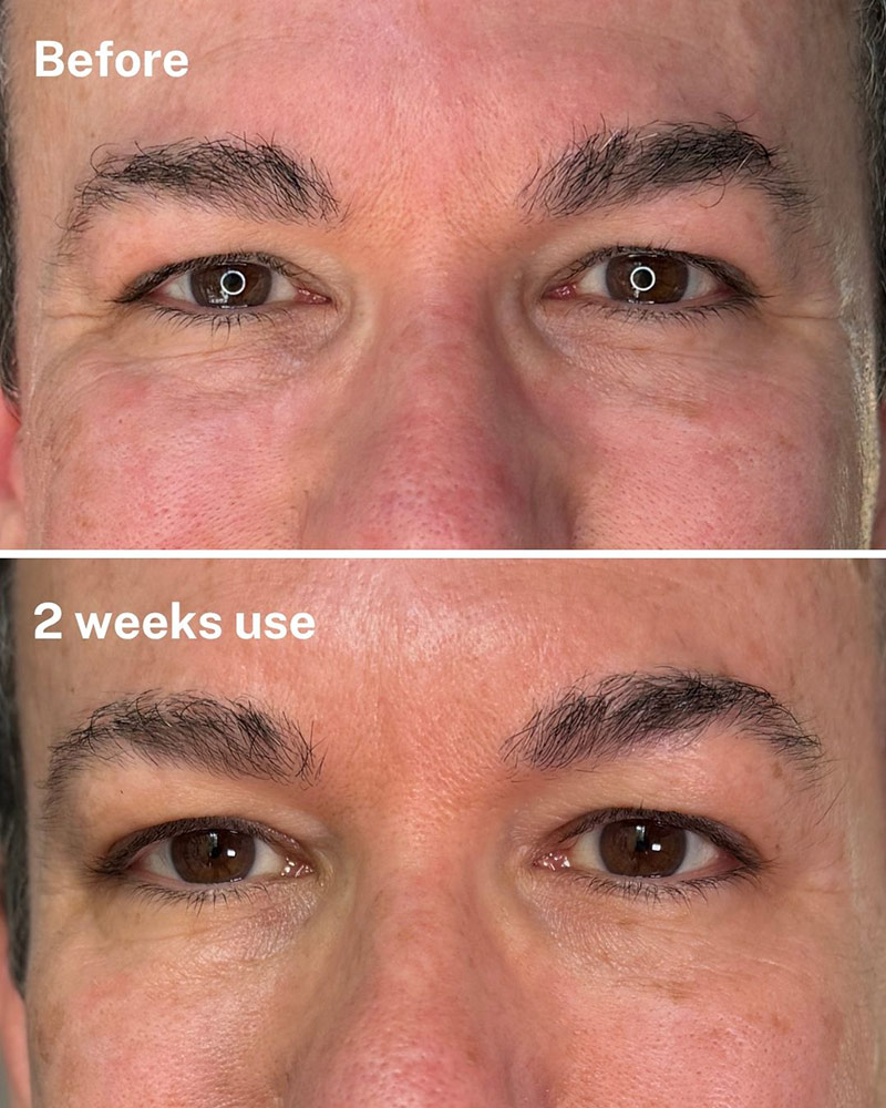 best anti-aging eye cream men dr diamond eyelift before after results