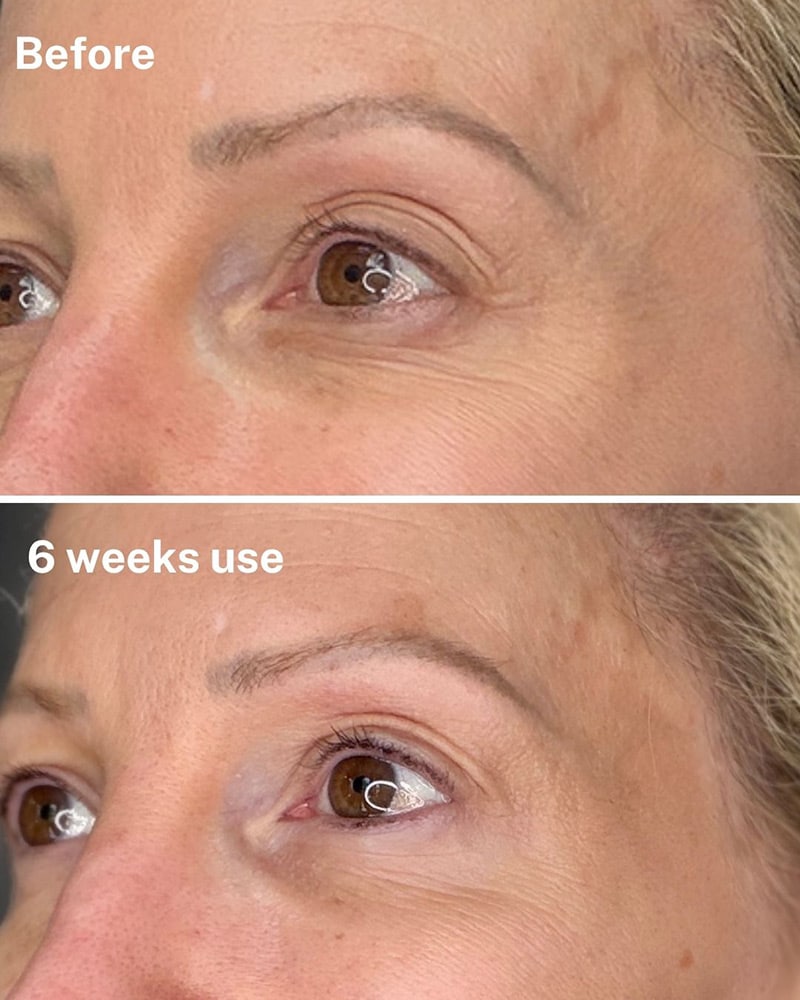 does dr diamond eyelift work before after real results