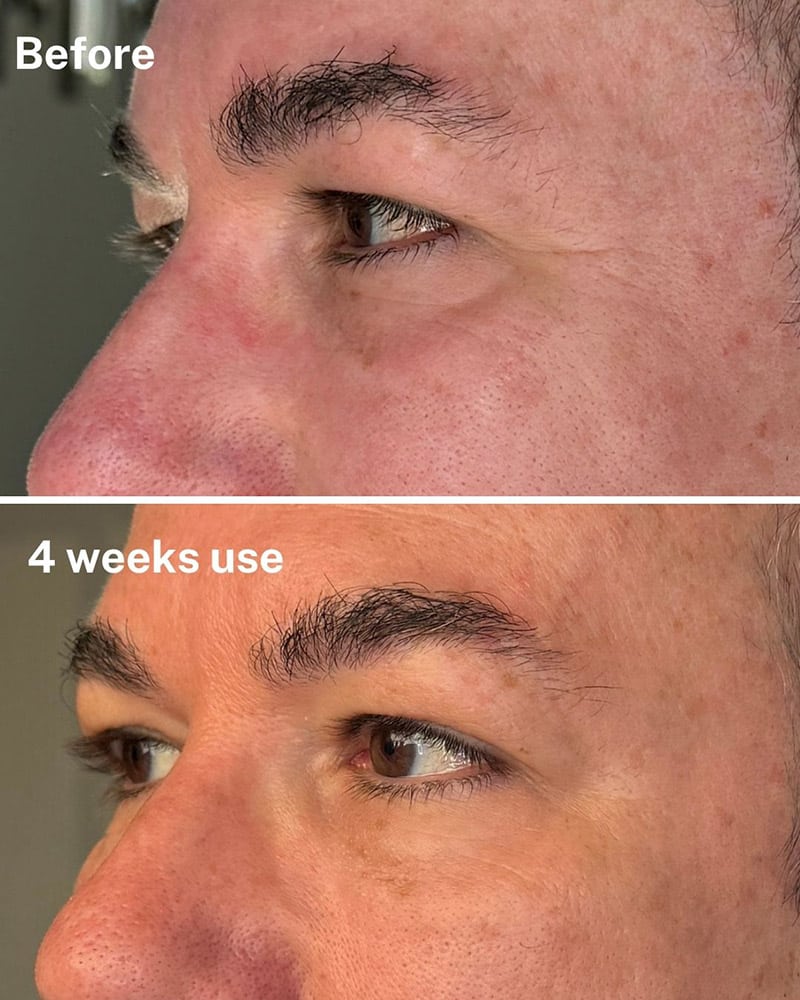 dr diamond eyelift results man before after hollow wrinkles
