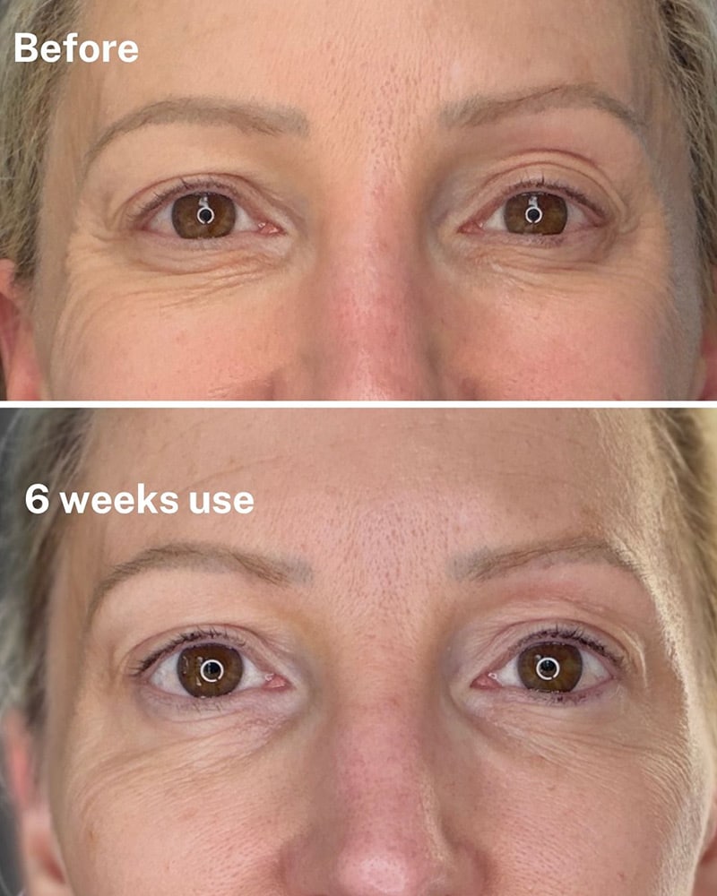 eye cream wrinkles dr diamond eyelift results real