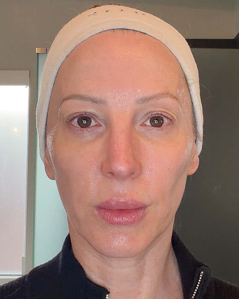 ZIIP Halo 2.0 before and after results  skin lifting tightening