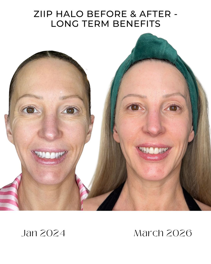  ZIIP Halo 2.0 before and after results skin lifting and tightening after 2 years
