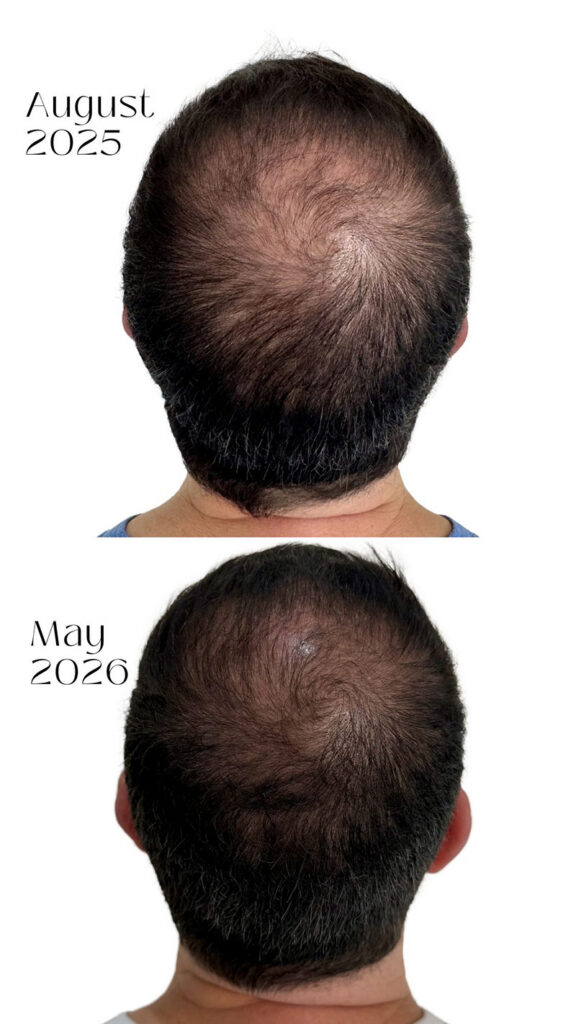 CurrentBody Skin led hair growth helmet before after results man