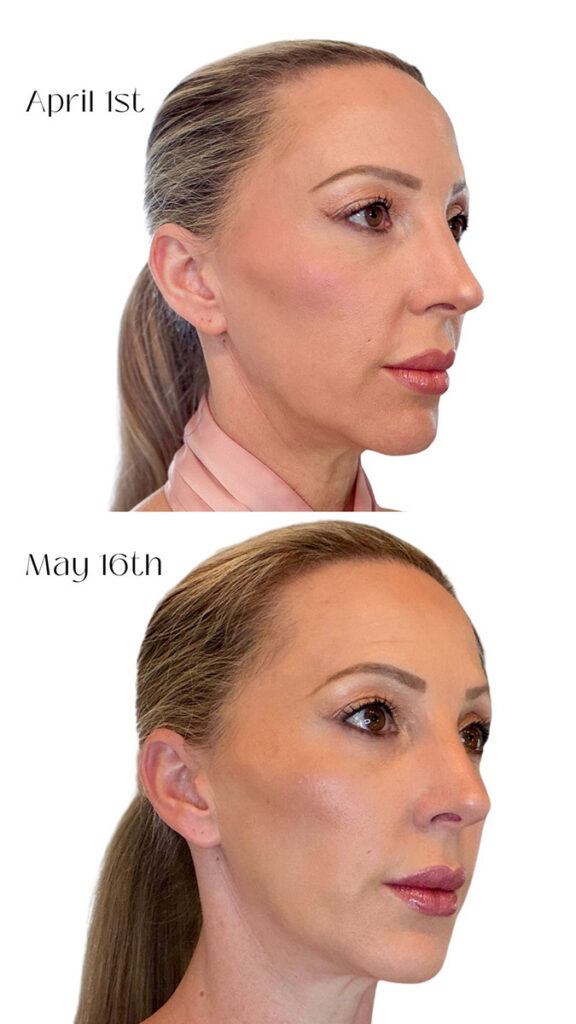CurrentBody led hair growth helmet before after results
