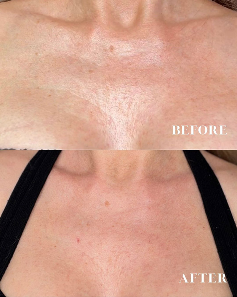 CurrentBody LED Neck & Décolletage Mask results before after