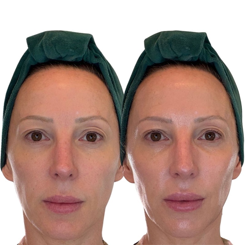 Emma Lewisham immediate results before after beauty editor Eve Dawes