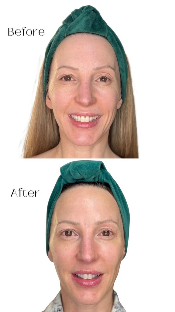 currentbody led mask series 3 before and after results