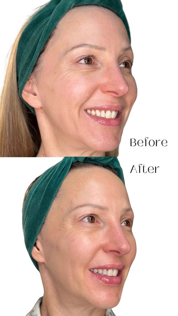 currentbody skin light therapy mask anti-aging results